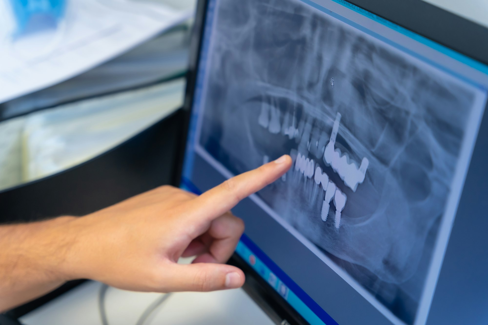 Dental clinic, dentist explaining to a client the teeth to be implanted with the computer