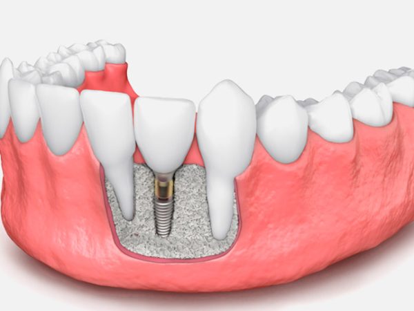 Regeneración-ósea-o-injerto-de-hueso-para-implantes-dentales