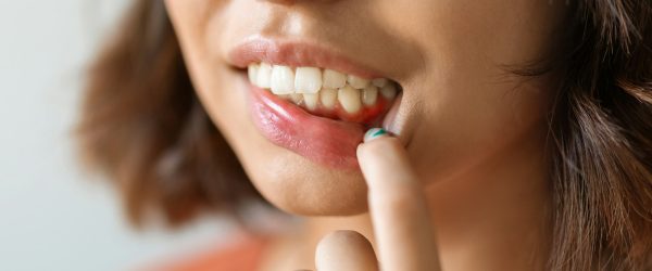 Gingivitis Concept. Young Woman Pulling Her Lip And Demonstrating Irritated Gums